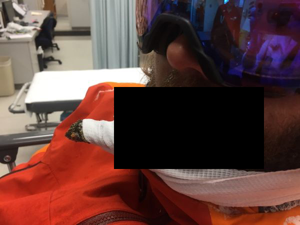 Лыжник проехал между двумя деревьями и поймал губой ветку