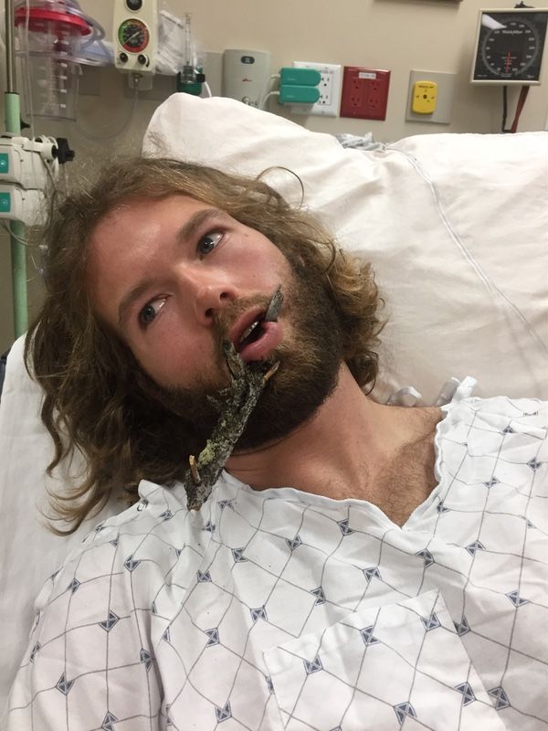 Лыжник проехал между двумя деревьями и поймал губой ветку