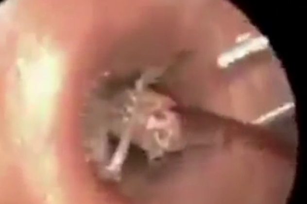 «Ушные квартиранты», или кого вытаскивали на белый свет врачи-отоларингологи?