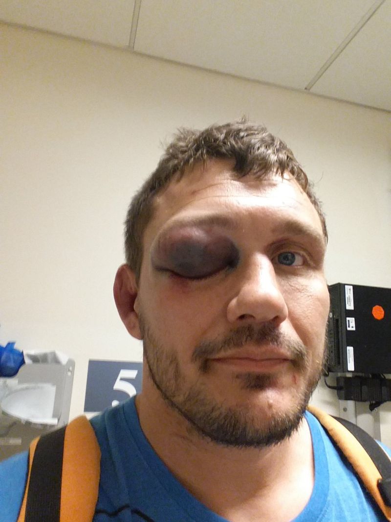 Самая отвратительная травма глаза в истории MMA