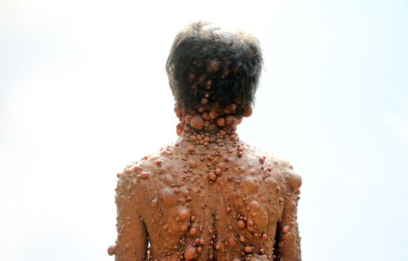 От мужчины, покрытого опухолями, шарахается даже собственный сын