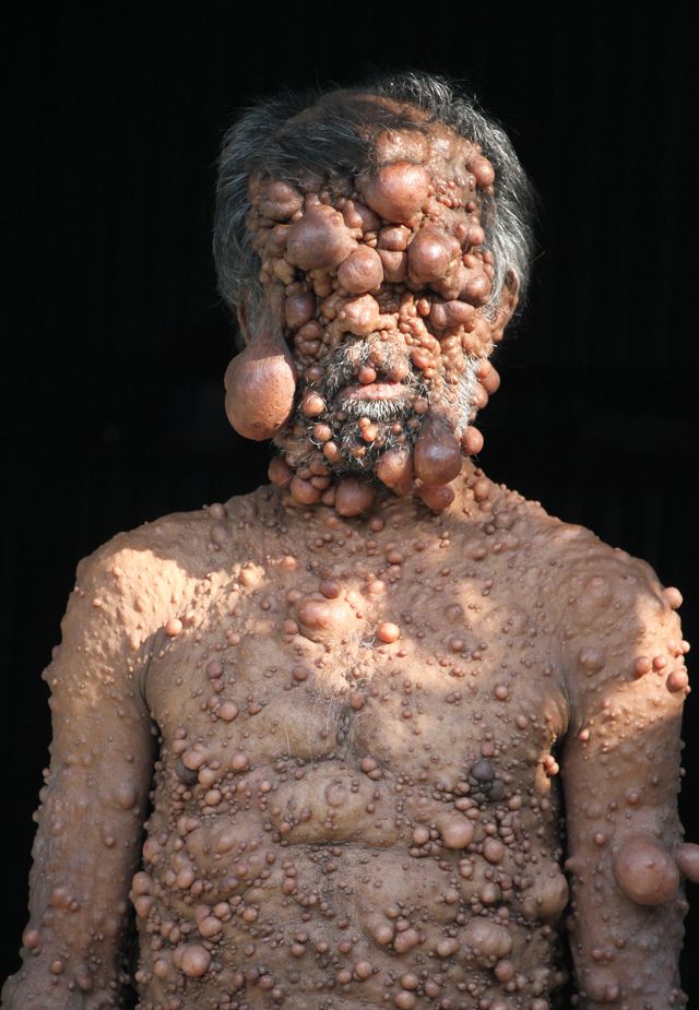 От мужчины, покрытого опухолями, шарахается даже собственный сын