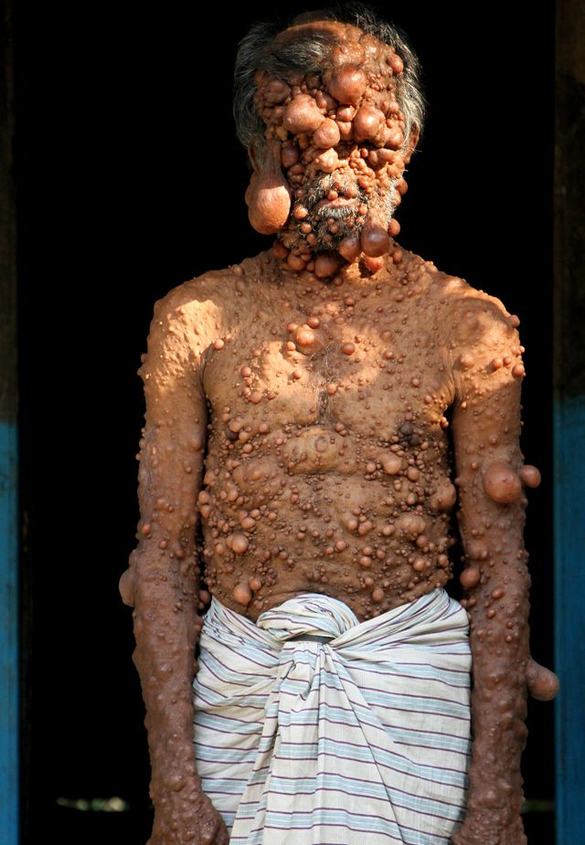 От мужчины, покрытого опухолями, шарахается даже собственный сын