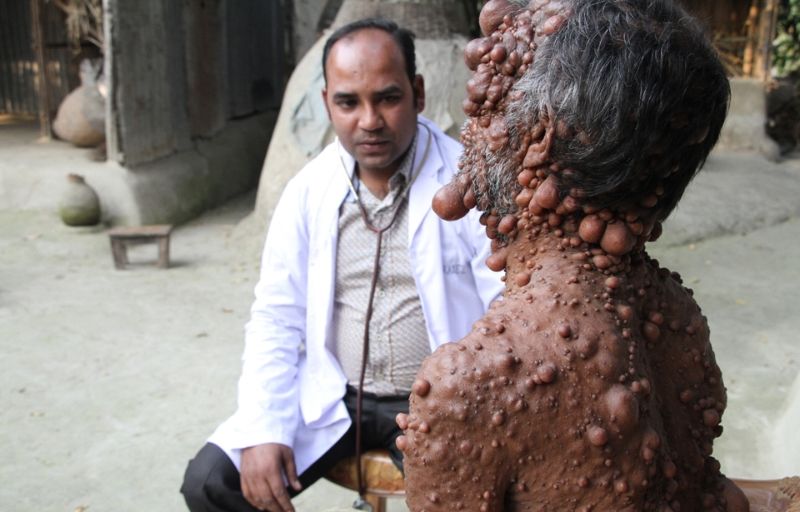 От мужчины, покрытого опухолями, шарахается даже собственный сын