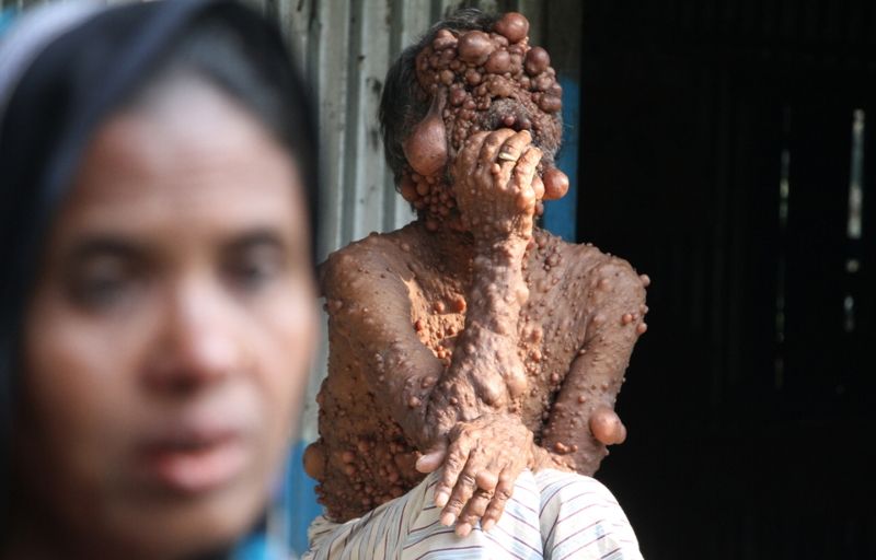 От мужчины, покрытого опухолями, шарахается даже собственный сын