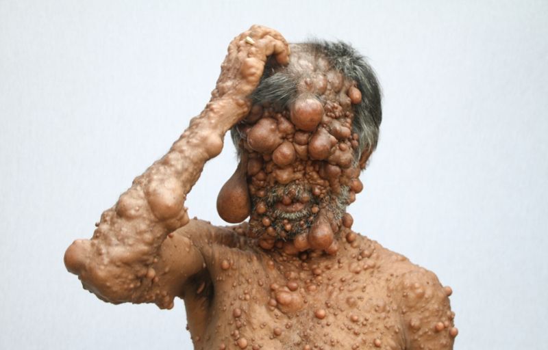 От мужчины, покрытого опухолями, шарахается даже собственный сын