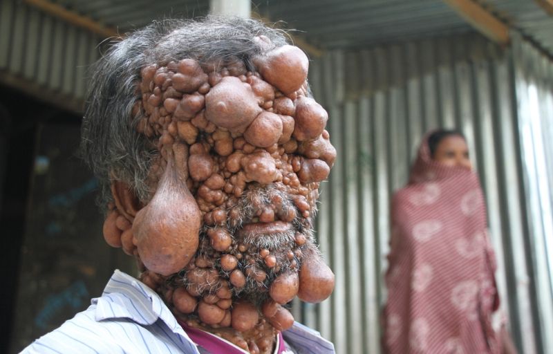 От мужчины, покрытого опухолями, шарахается даже собственный сын