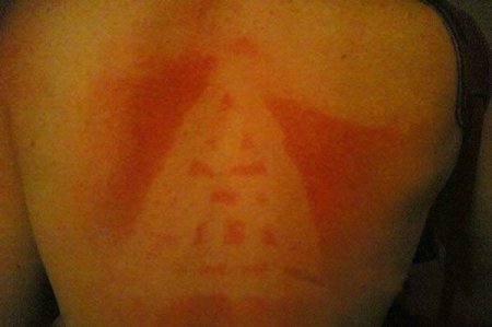 Как не надо загорать (26 фото)