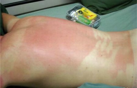 Как не надо загорать (26 фото)