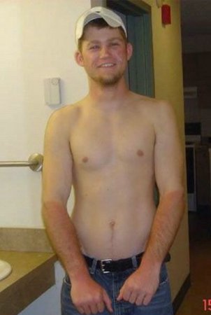 Как не надо загорать (26 фото)