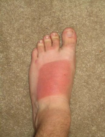 Как не надо загорать (26 фото)