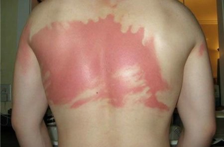 Как не надо загорать (26 фото)