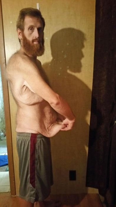 Американец похудел на 160 кг, чтобы не умереть