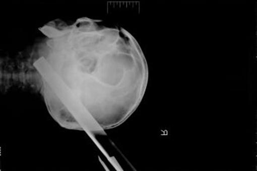 В Красноярске спасли мужчину с табуретом в голове