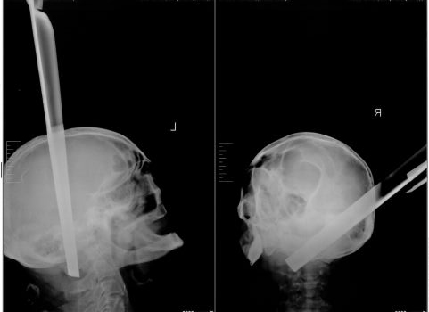 В Красноярске спасли мужчину с табуретом в голове