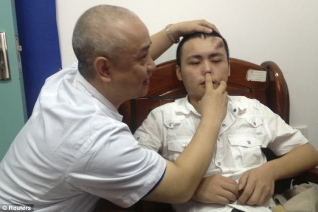 Китайские медики вырастили нос на лбу