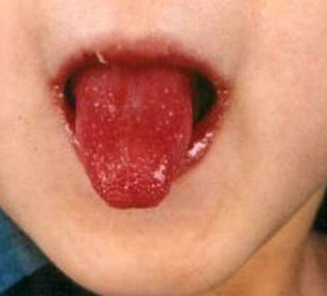 Загадочная болезнь Кавасаки приходит с ветрами из северо-восточного Китая Загадочная болезнь Кавасаки приходит с ветрами из северо-восточного Китая