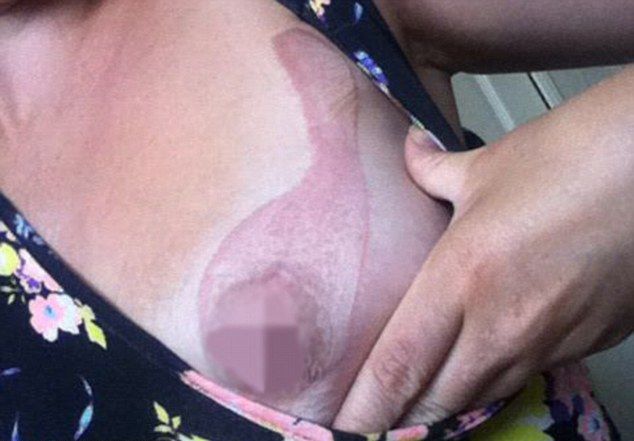 iPhone прожег дыру в груди девушки