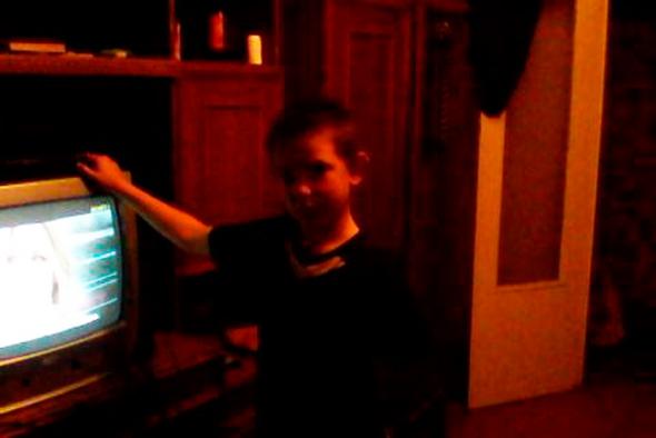 Шестиклассник Стас 5 дней жаловался на тугой гипс пока ему не ампутировали руку