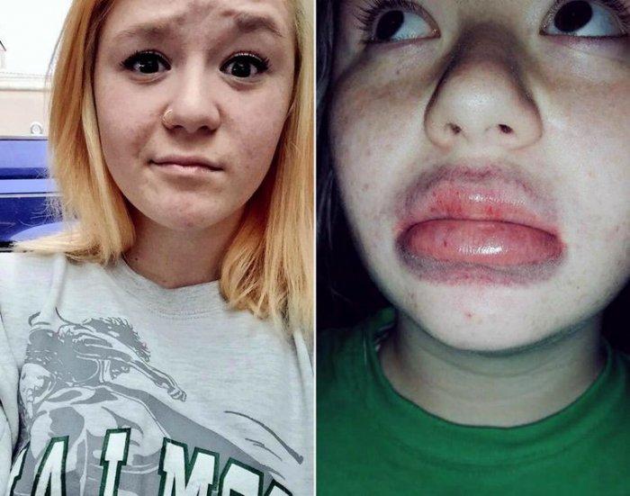 Подростки накачивают губы бутылками и стаканами