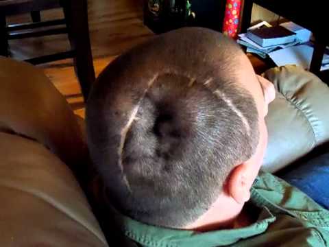 Если нет титановой пластины