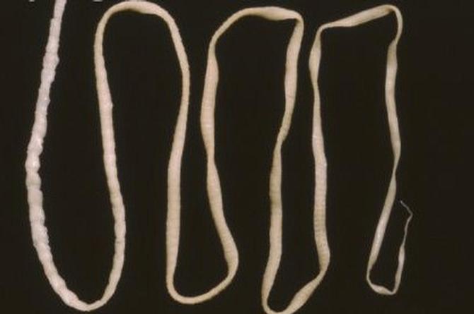 Из мозга парня достали живого ленточного червя