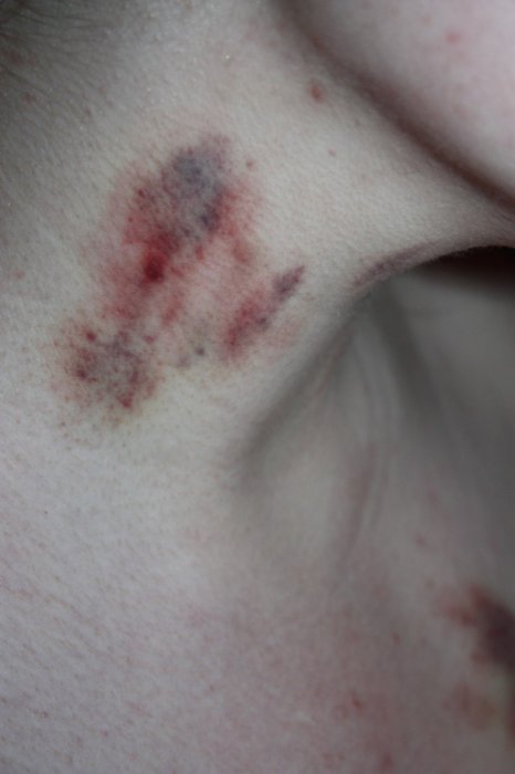  У школьницы нашли следы пыток