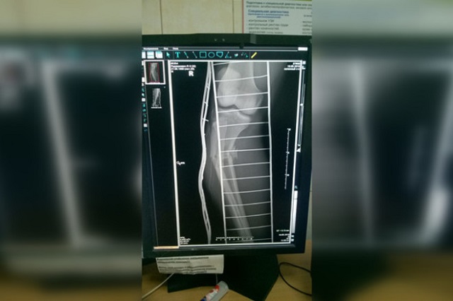 На чемпионате Евразии по пауэрлифтингу спортсмен Ярослав Радашкевич получил жуткую травму