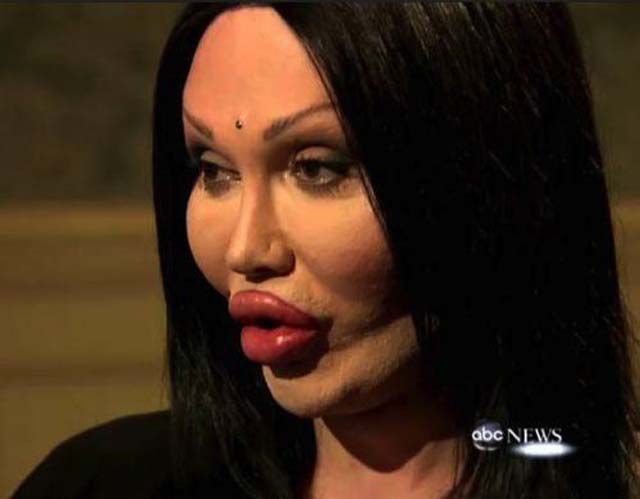 Жертвы пластической хирургии