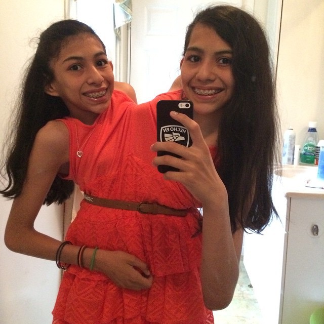 Лупита и Кармен Невероятная жизнь девочек-сиамских близнецов