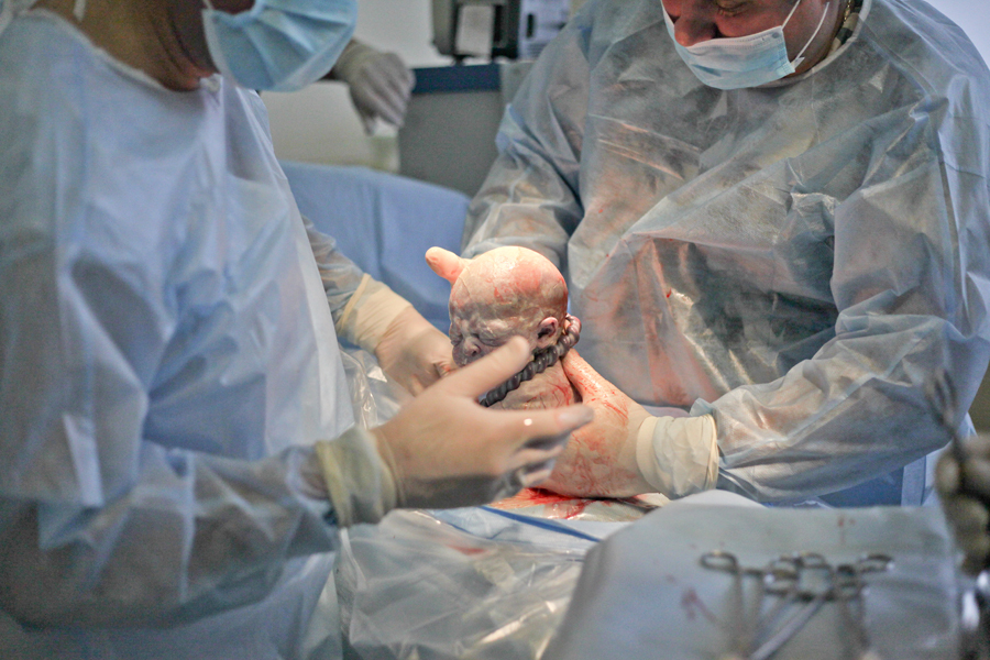 Кесарево сечение своими глазами