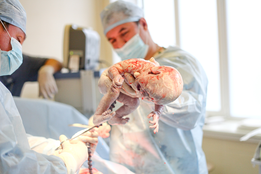 Кесарево сечение своими глазами