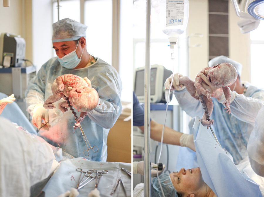 Кесарево сечение своими глазами