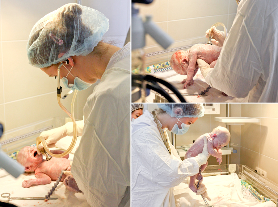 Кесарево сечение своими глазами