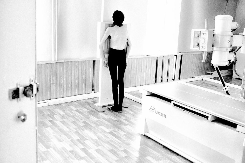 Туберкулез в СССР Туберкулез в СССР