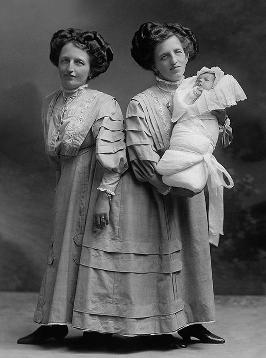 Удивительные истории о сиамских близнецах, у которых всё сложилось хорошо