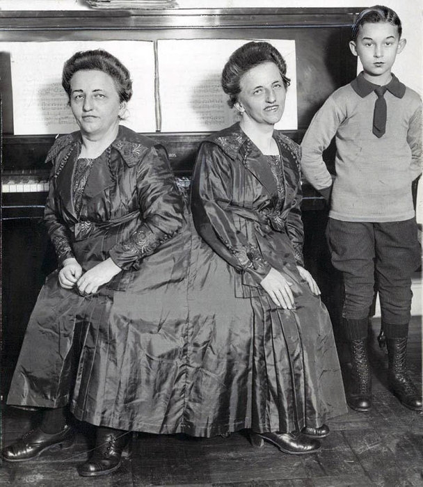 Удивительные истории о сиамских близнецах, у которых всё сложилось хорошо