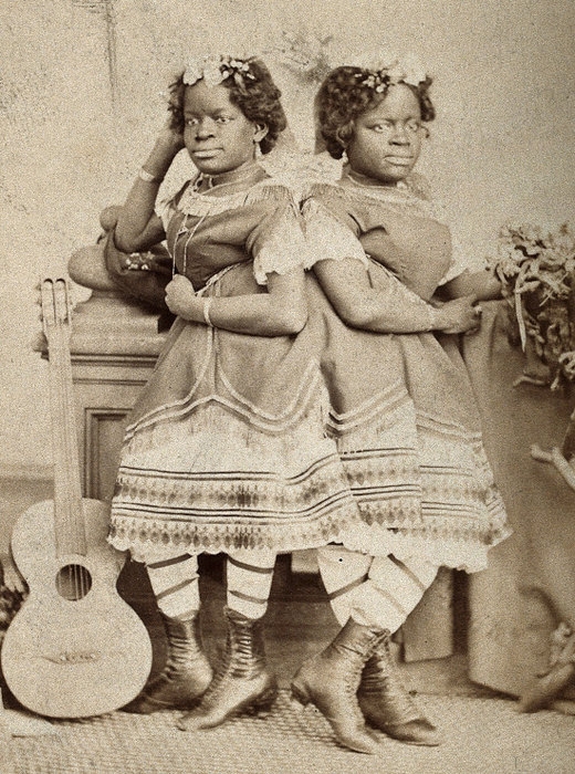 Удивительные истории о сиамских близнецах, у которых всё сложилось хорошо