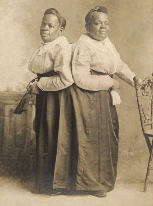 Удивительные истории о сиамских близнецах, у которых всё сложилось хорошо