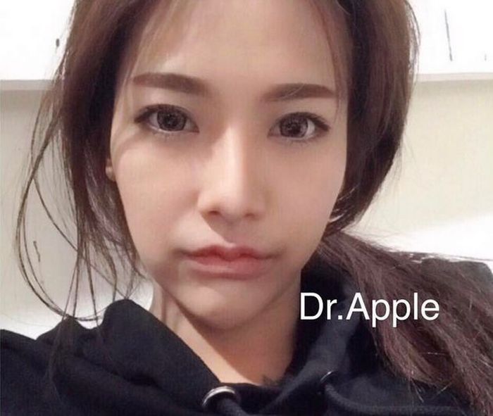 В Азии появился новый тренд в изменении формы губ