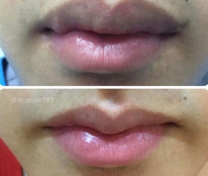 В Азии появился новый тренд в изменении формы губ