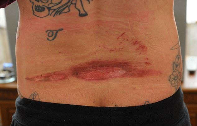 Травмы очередного вейпера от взрыва электронной сигареты