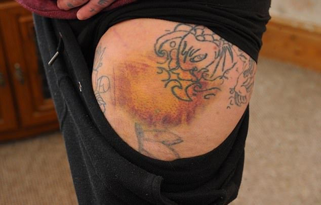 Травмы очередного вейпера от взрыва электронной сигареты