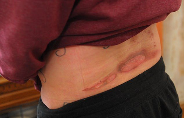 Травмы очередного вейпера от взрыва электронной сигареты