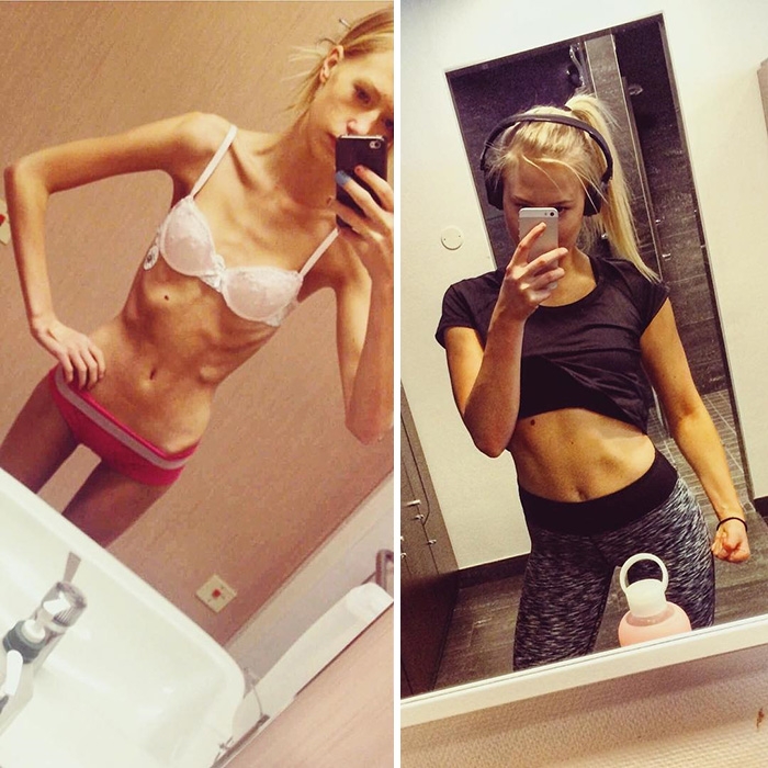 Потрясающее восстановление девушек, которые доказали, что анорексию можно победить