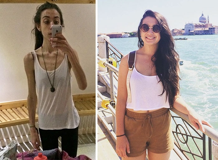 Потрясающее восстановление девушек, которые доказали, что анорексию можно победить