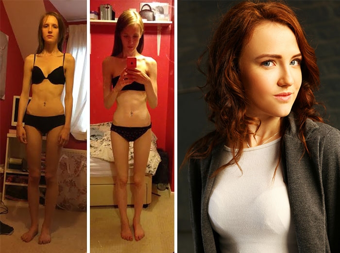 Потрясающее восстановление девушек, которые доказали, что анорексию можно победить