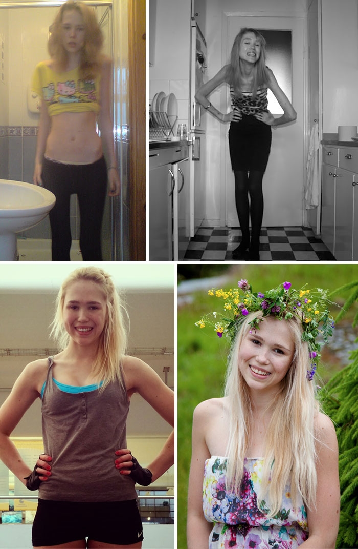 Потрясающее восстановление девушек, которые доказали, что анорексию можно победить