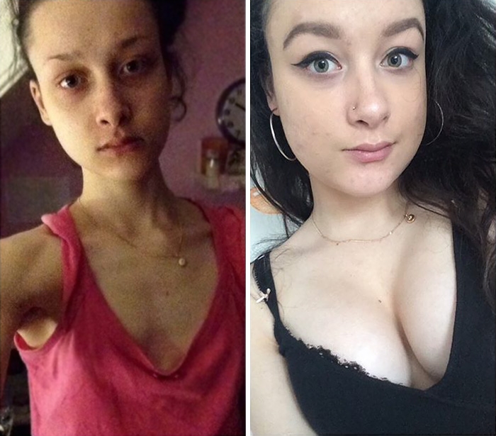 Потрясающее восстановление девушек, которые доказали, что анорексию можно победить