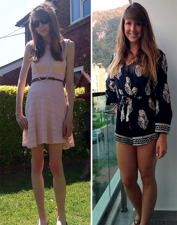 Потрясающее восстановление девушек, которые доказали, что анорексию можно победить